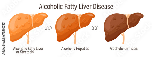 Types of fatty liver. Human liver diseases. Alcoholic fatty liver disease. Hepatitis, liver cirrhosis, fibrosis, steatosis. Medical infographic banner. Vector