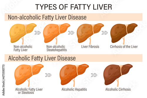 Types of fatty liver. Human liver diseases. Alcoholic and non-alcoholic fatty liver. Hepatitis, liver cirrhosis, fibrosis, steatosis. Medical infographic banner. Vector