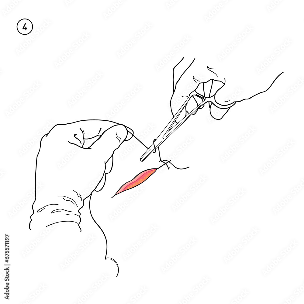 No 4, Simple Suture Techniques Stitching, Incision and Laceration