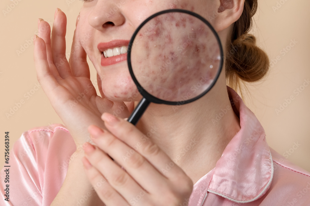 Young woman with acne problem and magnifier on beige background, closeup Young woman with acne problem and magnifier on beige background, closeup