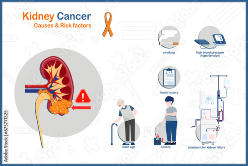 medical vector illustration concept of kidney cancer.causes and risk factors of kidney cancer,older age,smoking,obesity,high blood pressure,family history of kidney cancer,treatment for kidney failure