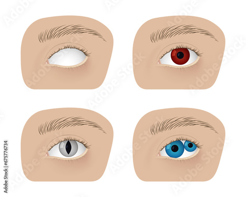 Realistic human healthy eye and with cataract vector illustration design.