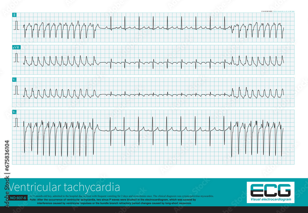 An 11 Month Old Male Infant Was Clinically Diagnosed With an-11-month-old-male-infant-was-clinically-diagnosed-with