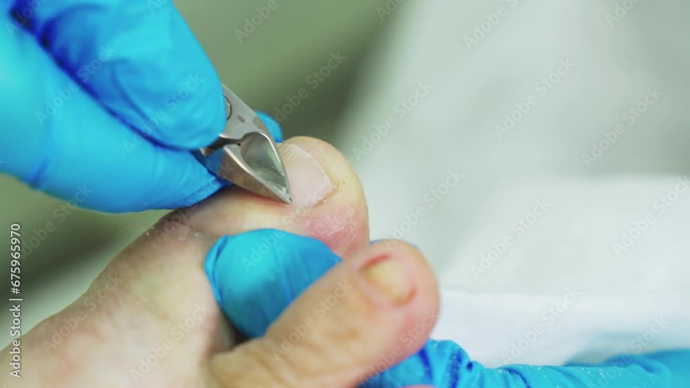 An orthopedic doctor in blue gloves removes dead skin tissue from the nail plate. Close-up. An orthopedic doctor in blue gloves removes dead skin tissue from the nail plate. Close-up.