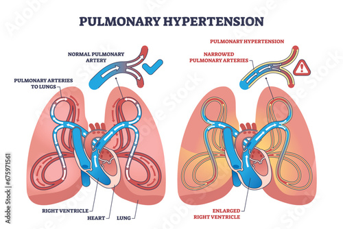 Pulmonary hypertension with narrow arteries and blockage outline diagram. Labeled educational scheme with medical condition comparison with healthy lungs and respiratory system vector illustration.