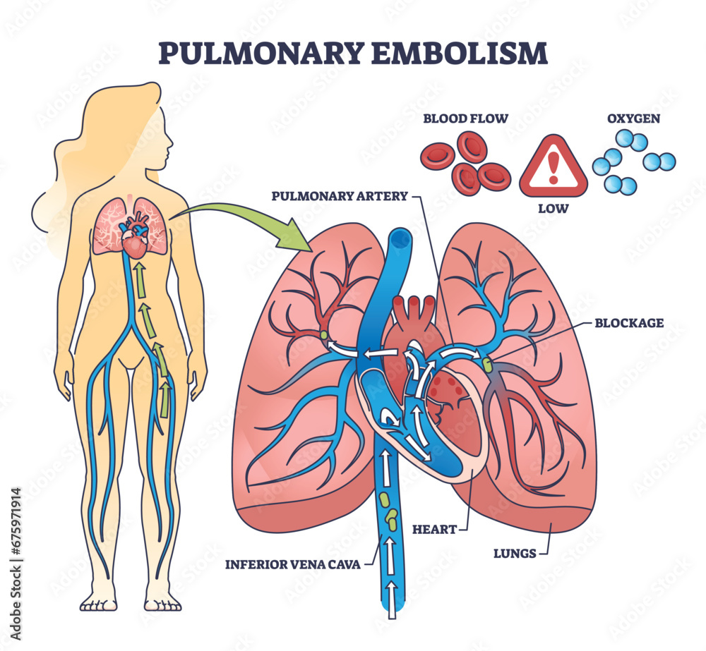 Pulmonary embolism with blood flow blockage in lung artery outline diagram. Labeled educational scheme with clot and thrombus from inferior vena cava vector illustration. Stroke disease and condition - obrazy, fototapety, plakaty 