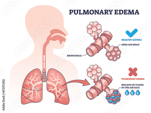 Pulmonary edema condition with fluid buildup in air sacs outline diagram. Labeled educational scheme with healthy and disease lungs medical comparison vector illustration. Respiratory bronchiole care photo