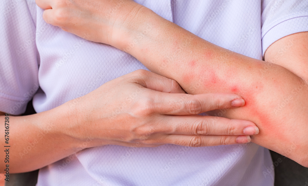 Close up of woman arm scratch the itch by hand at home, itching due to rash, fungus, allergy, dermatological disease, dry skin. Healthcare and medical concept.