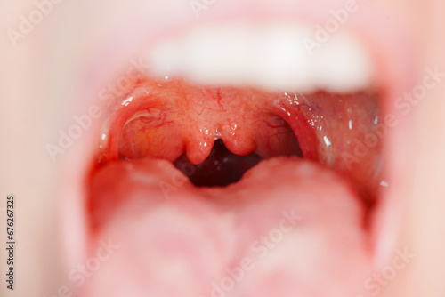 Foto Cleft, bifurcation of the uvula. congenital malformations.