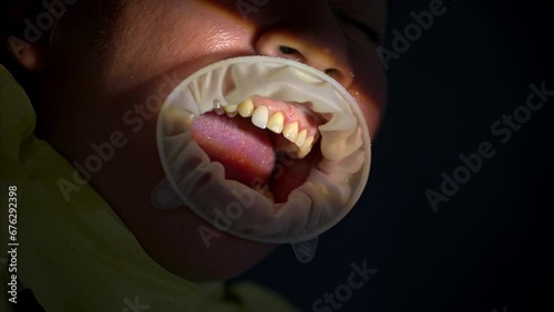 Dolly out shot of a dentist's patient mouth open while getting new ceramic composite veneers. photo