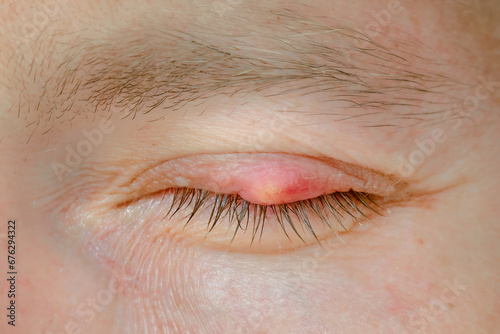 Chalazion, slow-growing lump or cyst that develops within the eyelid. Burst abscess, inflamed area of the eyelid. Eye diseas with swollen, inflamed eyelid. Chalazion on upper eyelid closeup. photo