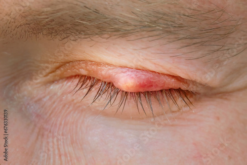 Obraz na plátně Burst abscess, inflamed area of the eyelid