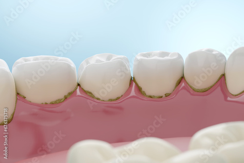 Dental tartar at molar teeth for tartar and tooth plaque removal blue background. 3D rendering. photo
