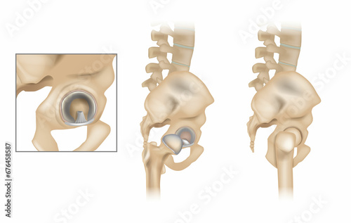 Anatomy of the Hip and Acetabular Labrum. Ligamentum teres and Articular cartilage. Lateral view with femur of right hip. photo