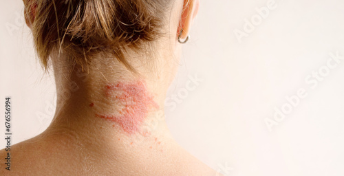 Manifestation of atopic dermatitis as a red itchy spot on a woman’s neck, close-up, rear view, copy space. Dermatology, allergy, itching, red spot or rash on skin photo