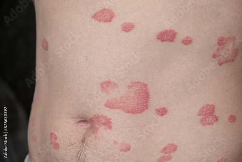 Psoriasis Vulgaris, skin patches are typically red, itchy, and scaly. Papules of chronic psoriasis vulgaris on male hand, back and body. Genetic immune disease. Detail of psoriatic skin disease 