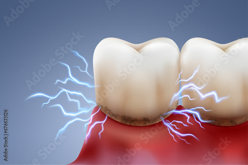 Plaque and tooth sensitivity Electric sparks are like the sharp pain in your teeth caused by plaque and gum inflammation. Dental treatment and protection. Realistic vector illustration file. photo