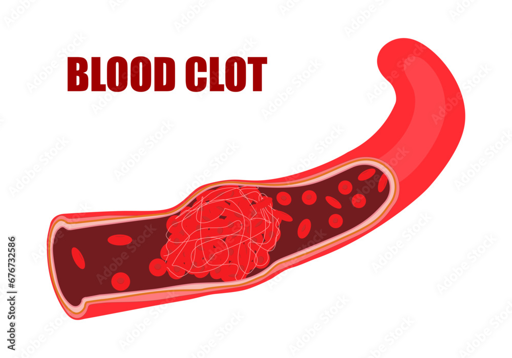 Blood clots are clumps that occur when blood hardens from a liquid to a