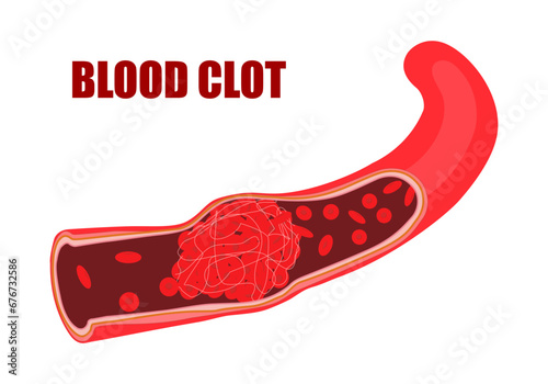 Blood clots are clumps that occur when blood hardens from a liquid to a solid. A blood clot that forms inside one of your veins or arteries is called a thrombus. A thrombus may also form in your heart