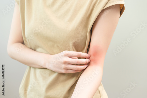 Dermatology asian young woman, girl allergy, allergic reaction from atopic, insect bites on her arm, hand in scratching itchy, itch red spot or rash of skin. Healthcare, treatment of beauty.