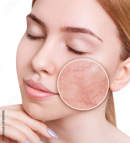 Young woman with couperose on face skin in zoom circle.