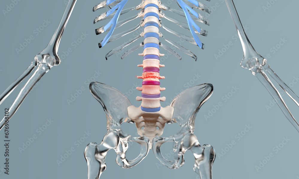 Compression fracture in the lumbar spine with glass skeleton - obrazy, fototapety, plakaty 