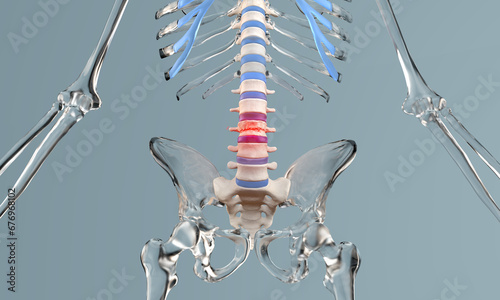 Compression fracture in the lumbar spine with glass skeleton photo