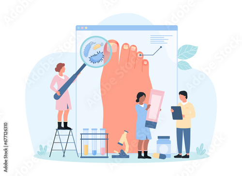 Diagnosis and treatment of fungal infection and nail disease, onychomycosis vector illustration. Cartoon tiny doctors with magnifying glass diagnose microbes on feets skin, advise antifungal treatment photo