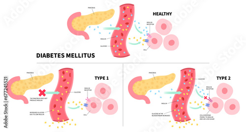Glucagon hormone of Diabetes mellitus type 1 and 2 with insulin injection diagram of chronic metabolism disease anatomy photo