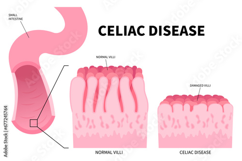 The small intestinal of Celiac disease with Stomach bacterial and Crohn's disorder that cause pain or fatty stools in medical photo