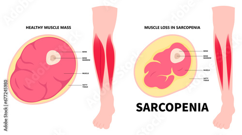 Leg muscle loss the Sarcopenia disorder that cause arm in older adults with body nerve pain injury of limb by low nutrition after aging