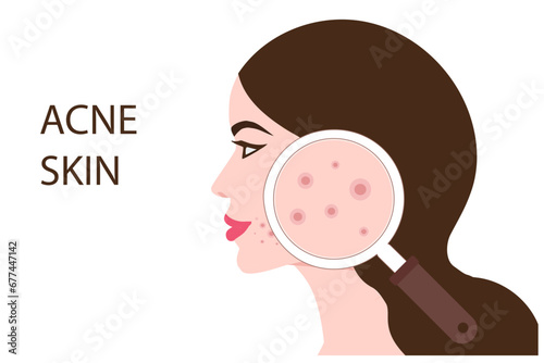 Young woman face with skin acne, pimples, blackheads vector illustration. Acne skin face problem concept