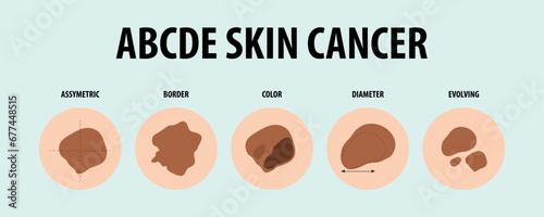 Illustrated Guide to Five Types of Skin Cancer