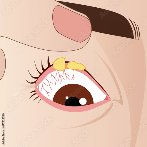 Stye internal eye or hordeolum, bacterial disease infection, illustration photo