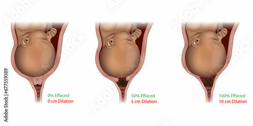 Cervical Effacement and Dilation During Delivery. Labor or delivery. Cervix changes from not effaced and dilated to fully effaced and totally photo