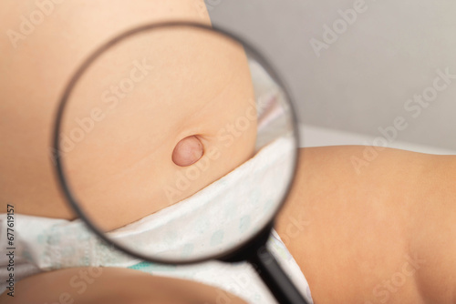 An umbilical hernia in a child on the stomach through a magnifying glass. Treatment of dilated umbilical ring, medical. Close-up