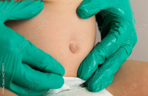 Doctor's hands in green medical gloves examine an umbilical hernia in a child, close-up.