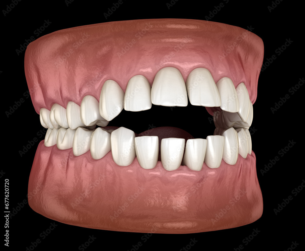 Openbite dental occlusion (Malocclusion of teeth). Medically accurate tooth 3D illustration Openbite dental occlusion (Malocclusion of teeth). Medically accurate tooth 3D illustration