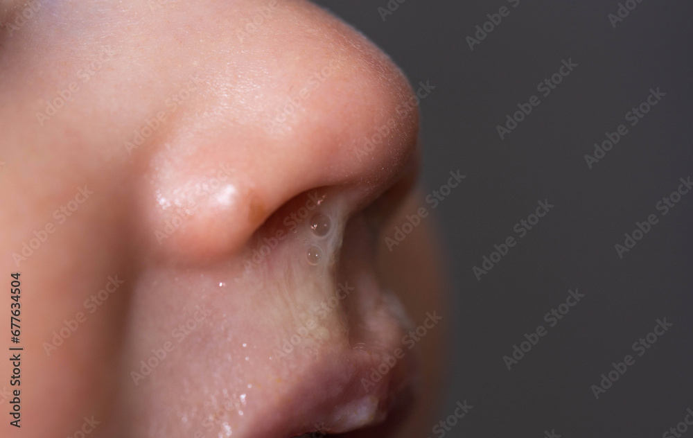 Close-up of a small child's face and nose with snot. The concept of colds, rhinitis and runny nose in children. Close-up of a small child's face and nose with snot. The concept of colds, rhinitis and runny nose in children.