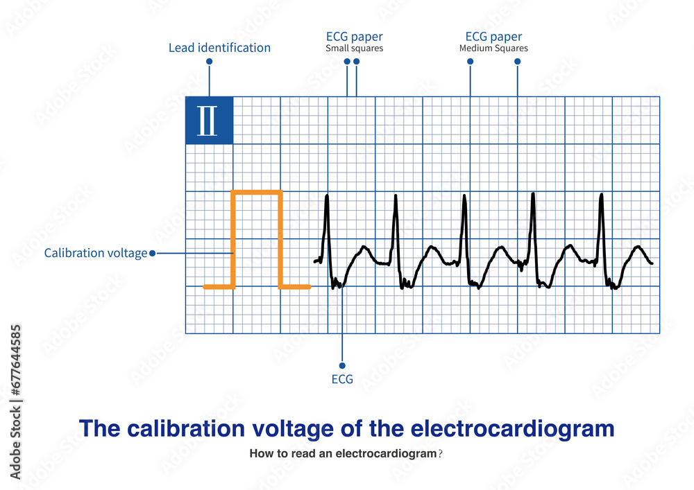 Under daily working parameters, the calibration voltage setting of the electrocardiogram machine is to input 1mV voltage with an amplitude deviation of 10mm, i.e. 1mm=0.1mV.