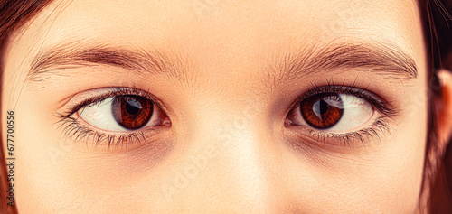 Strabismus. Little patient strabismus, treatment ophthalmic diseases. Strabismus in children causes, treatment concept. Female eyes with strabismus. Hypertropia photo