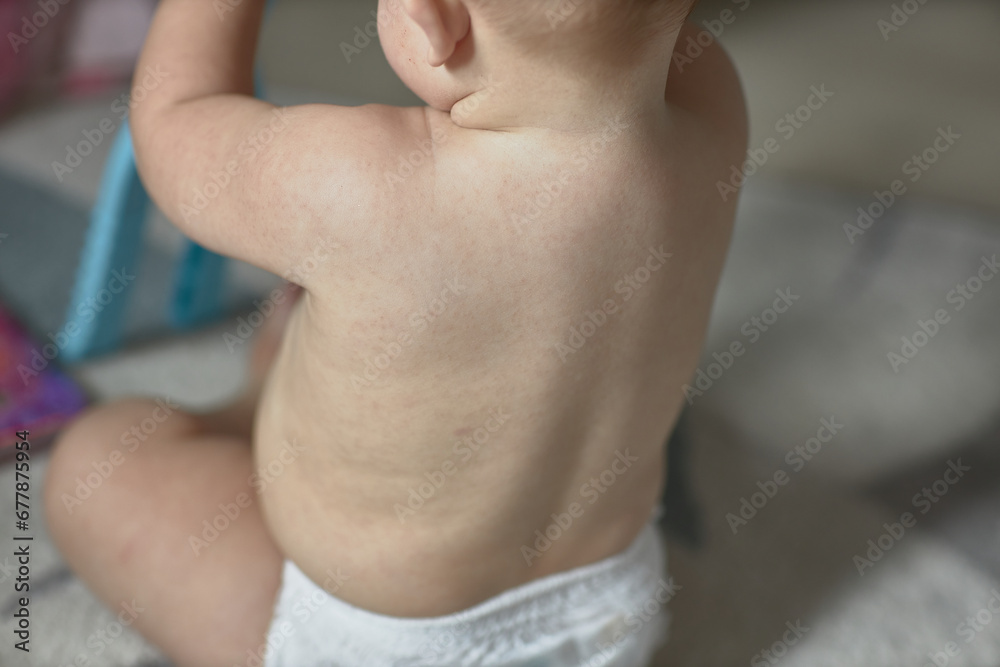 A baby's rash, a rash on the skin, a harmless non-dangerous viral ...