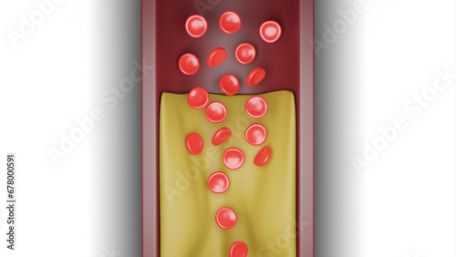 Hyperlipidemia. Blocked artery concept and human blood vessel as a disease with cholesterol fat buildup clogging. photo