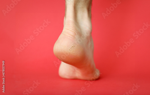Heel with a cracked skin disease on a red background