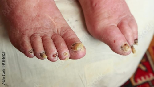 onychodystrophy on the toenails of an elderly person. Pedicure on toes, podology. Close-up photo