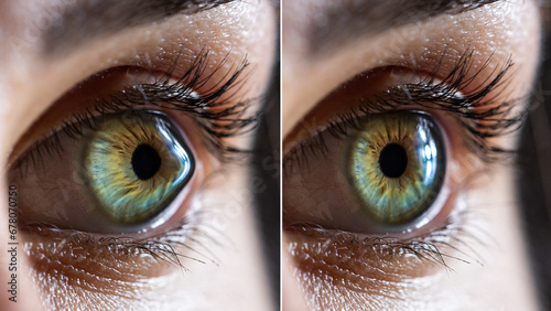 Macro of a clear female eye with keratoconus before and after surgery photo