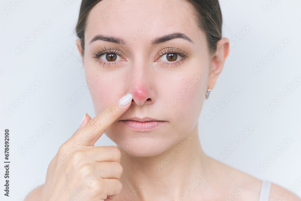 a close-up portrait of a young dark-haired woman pointing with her index finger at a large red pimple on the tip of her nose and looking into the camera. Dermatology, acne, problems. a close-up portrait of a young dark-haired woman pointing with her index finger at a large red pimple on the tip of her nose and looking into the camera. Dermatology, acne, problems.