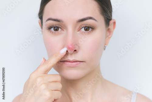 a close-up portrait of a young dark-haired woman pointing with her index finger at a large red pimple on the tip of her nose and looking into the camera. Dermatology  acne  problems. 