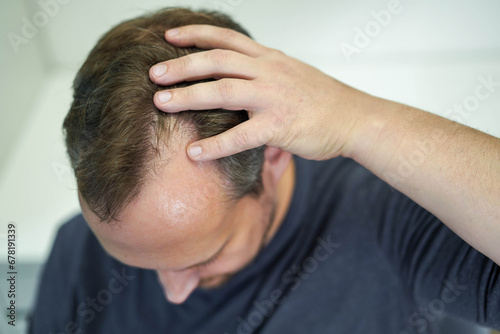 Baldness on the head of a middle-aged man. Hair loss. photo