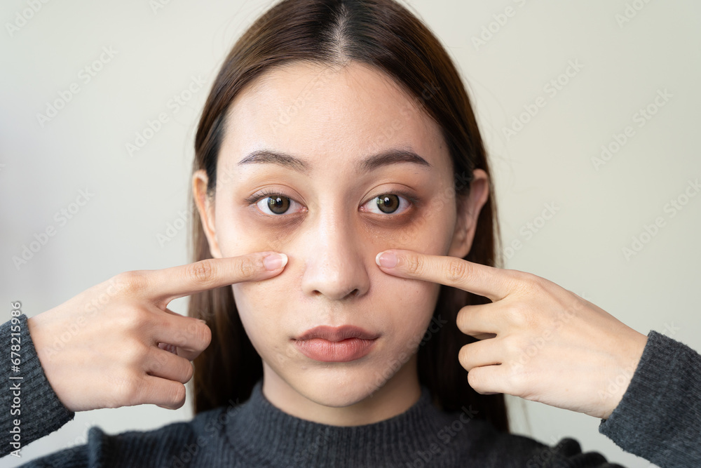 lack of sleep problem, Worried Asian young woman pointing finger at dark circles under her eyes lack of sleep problem, Worried Asian young woman pointing finger at dark circles under her eyes